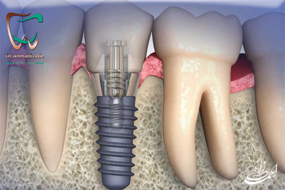 انواع روش ایمپلنت دندان