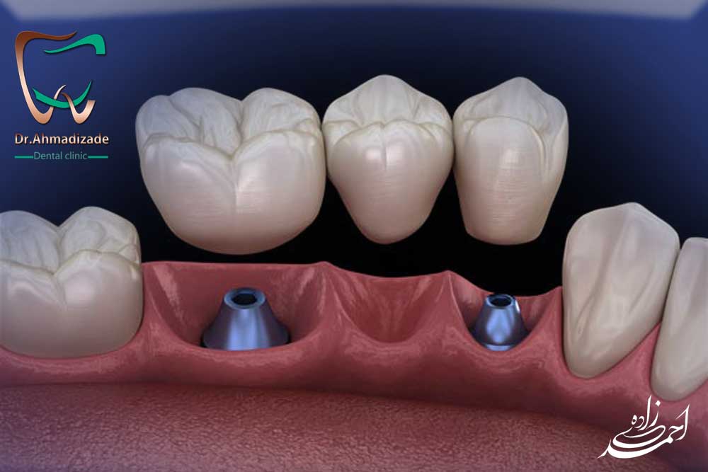 عوارض جانبی ایمپلنت دندان
