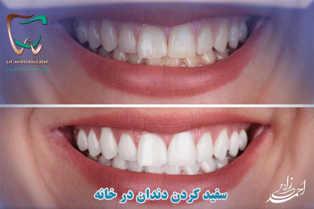 سفید کردن دندانها چه روشهایی دارد؟